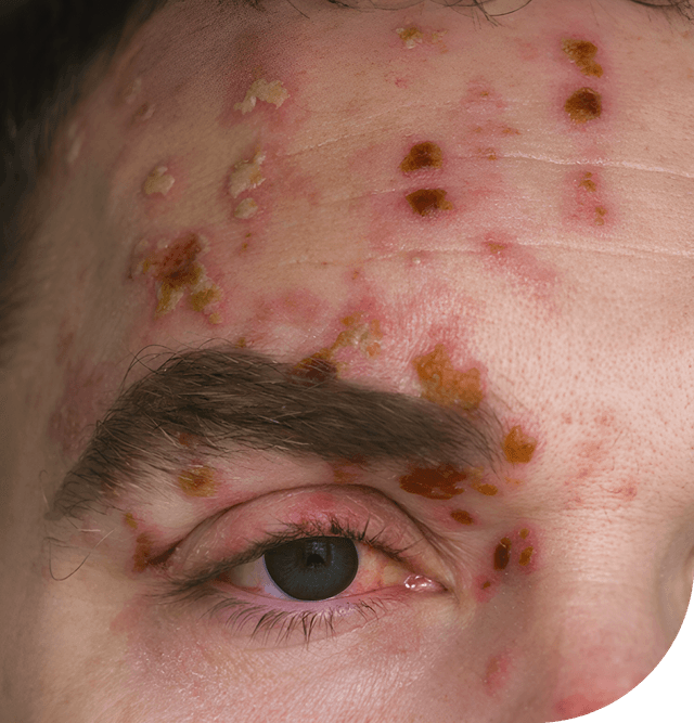 Shingles on skin